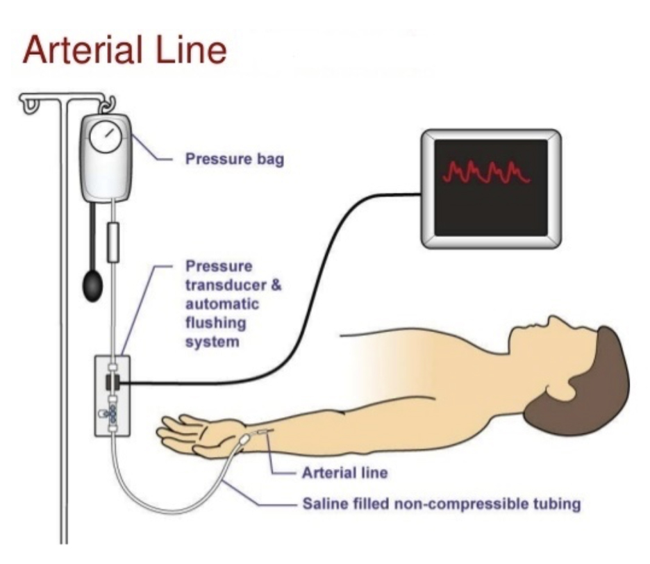 arterial line patient